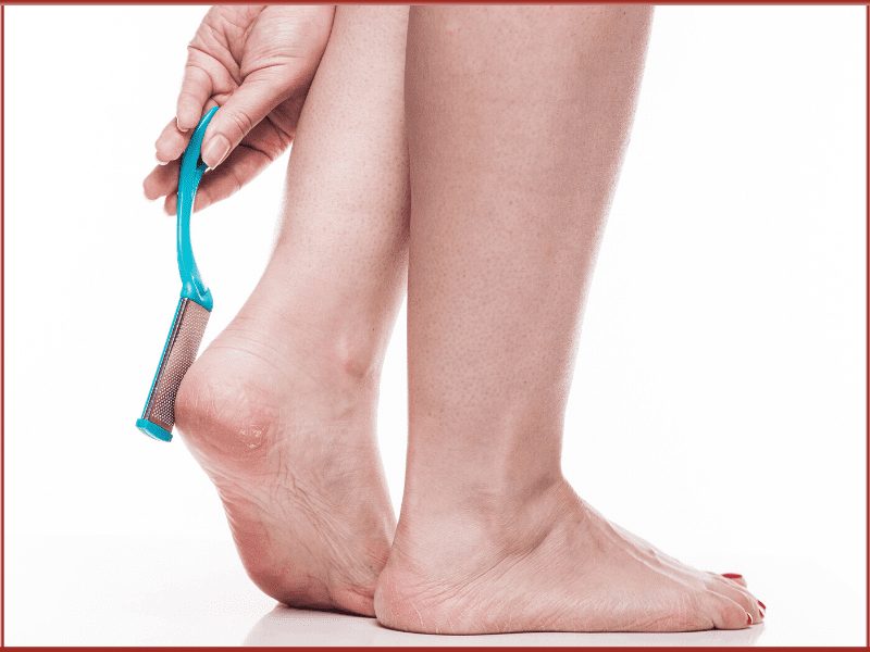 Prevention Tips For Cracked Heels