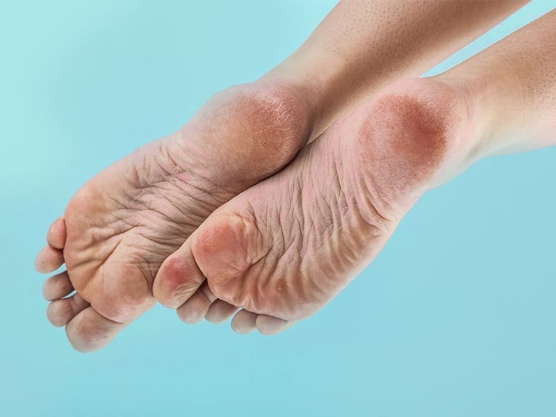 Reasons For Cracked Heels