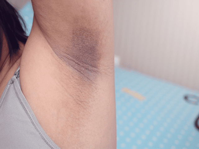 Dark Underarms Due to Melasma