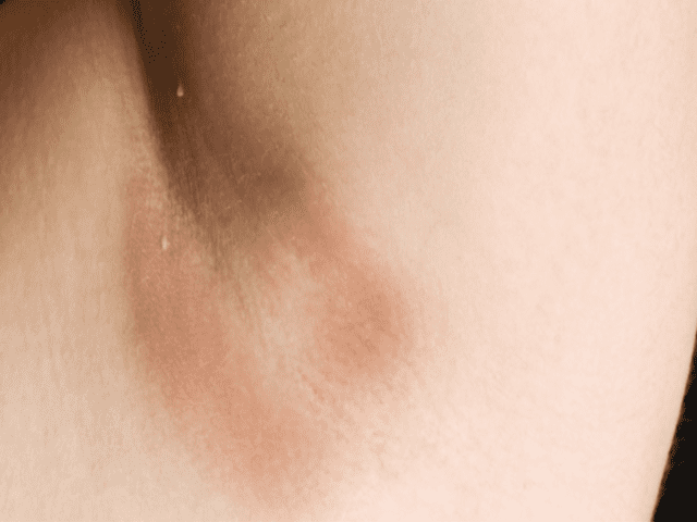 Dark Underarms Due To Bacterial Infection