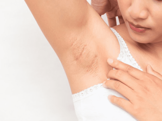 Accumulation Of Dead Skin Causing Dark Underarms